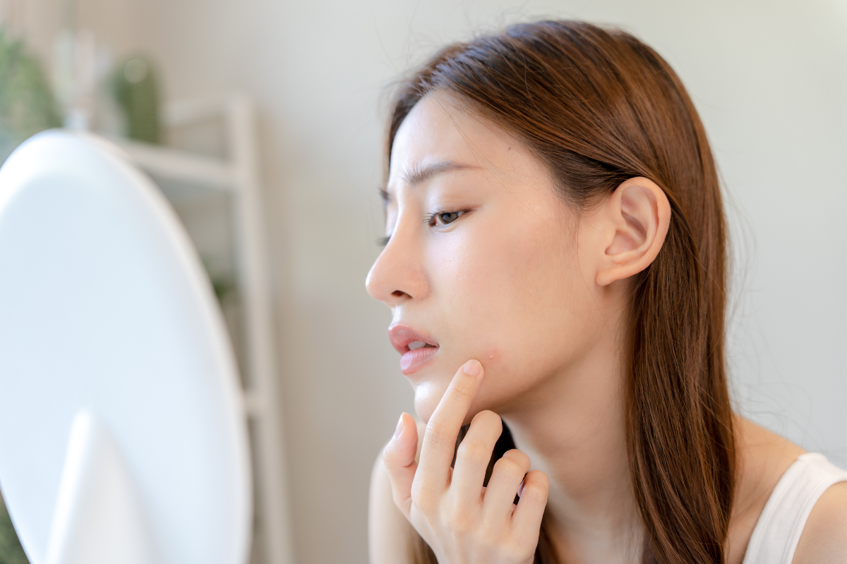 ゼオスキンはニキビに効果的?ニキビ跡への効果やおすすめ製品を紹介